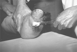 Cleaning a leprous foot